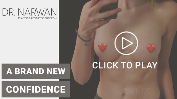 Thumbnail Video Breast Surgery Result, Dr. Narwan, Plastic and Aesthetic Surgery Dubai