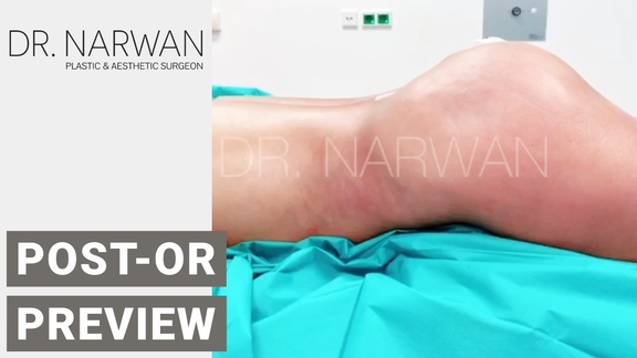 Thumbnail Video Post-Or Preview, Dr. Narwan, Plastic and Aesthetic Surgery Dubai