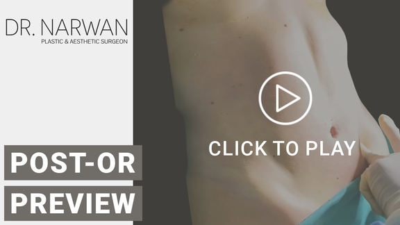 Thumbnail Video Post-Or Preview, Dr. Narwan, Plastic and Aesthetic Surgery Dubai