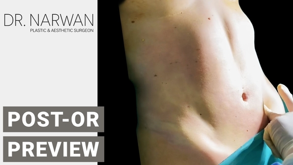 Thumbnail Video Post-Or Preview, Dr. Narwan, Plastic and Aesthetic Surgery Dubai