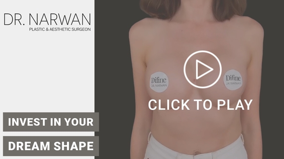 Thumbnail Video Breast Surgery Result, Dr. Narwan, Plastic and Aesthetic Surgery Dubai