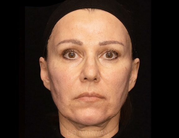 Treatment Full Face, Dr. Narwan, Plastic and Aesthetic Surgery Dubai