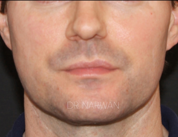 treatment-full-face-12-dr-narwan-plastic-aesthetic-surgeon-dubai.jpg 