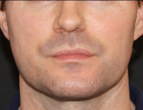 Treatment Full Face, Dr. Narwan, Plastic and Aesthetic Surgery Dubai