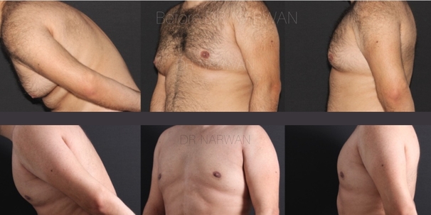 treatment-gynecomastia-02-dr-narwan-plastic-aesthetic-surgeon-dubai.jpg 