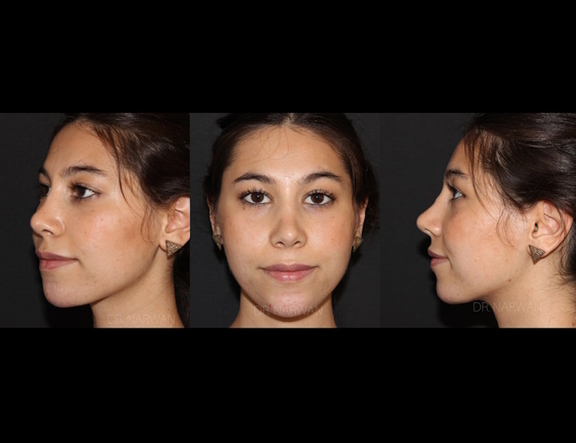 Treatment Full Face, Dr. Narwan, Plastic and Aesthetic Surgery Dubai