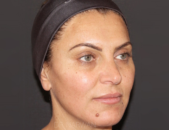 Treatment Full Face, Dr. Narwan, Plastic and Aesthetic Surgery Dubai