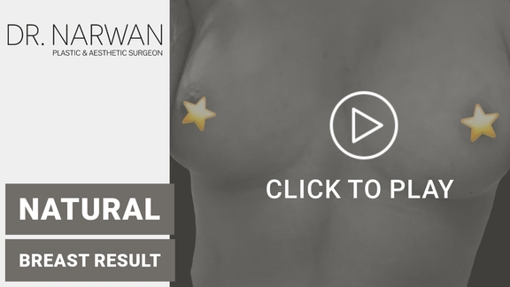 Thumbnail Video Breast Surgery Result, Dr. Narwan, Plastic and Aesthetic Surgery Dubai