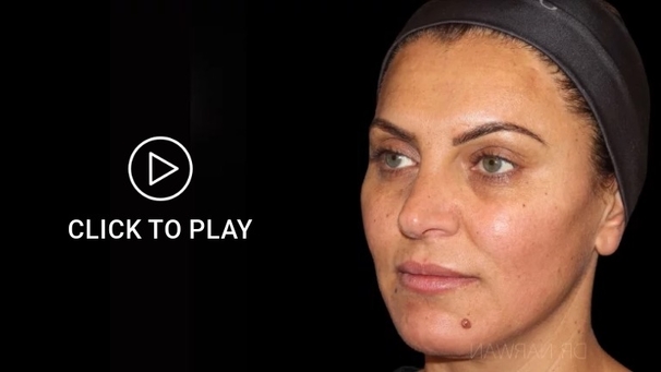 Dr. Narwan, Injections Face, Plastic and Aesthetic Surgery Dubai