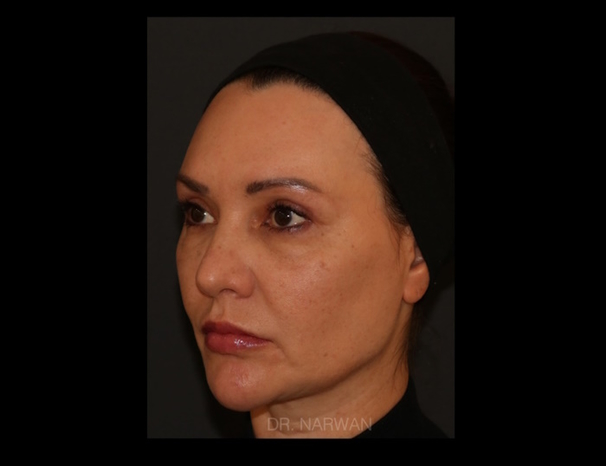 treatment-full-face-03-dr-narwan-plastic-aesthetic-surgeon-dubai.jpg 