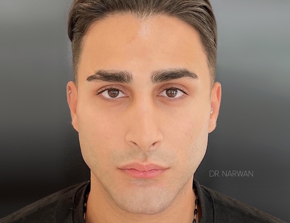 Treatment Full Face, Dr. Narwan, Plastic and Aesthetic Surgery Dubai