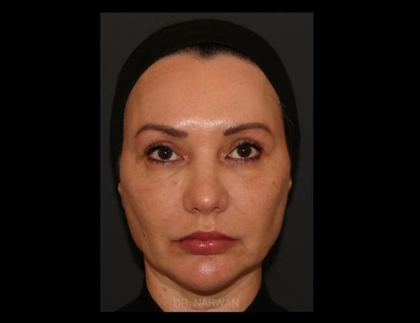 treatment-full-face-01-dr-narwan-plastic-aesthetic-surgeon-dubai.jpg 