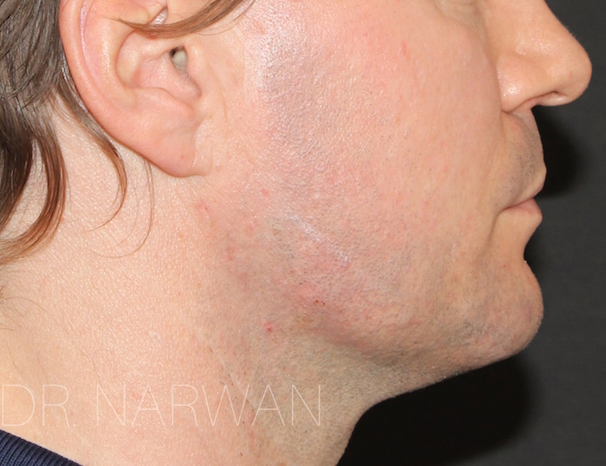 treatment-full-face-13-dr-narwan-plastic-aesthetic-surgeon-dubai.jpg 