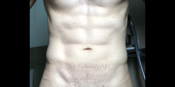 treatment-body-men-08-dr-narwan-plastic-aesthetic-surgeon-dubai.png 