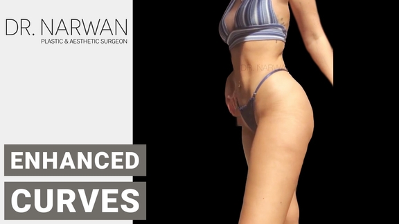 Thumbnail Video Enhanced Curves, Dr. Narwan, Plastic and Aesthetic Surgery Dubai