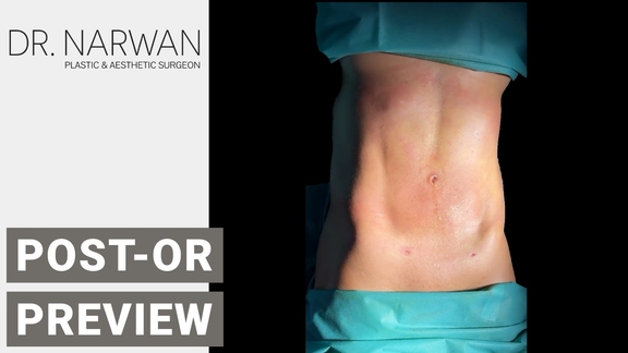 Thumbnail Video Post-Or Preview, Dr. Narwan, Plastic and Aesthetic Surgery Dubai