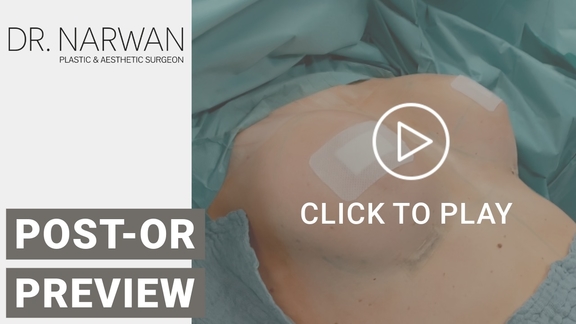 Thumbnail Video Breast Surgery Result, Dr. Narwan, Plastic and Aesthetic Surgery Dubai
