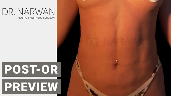 Thumbnail Video Post-Or Preview, Dr. Narwan, Plastic and Aesthetic Surgery Dubai