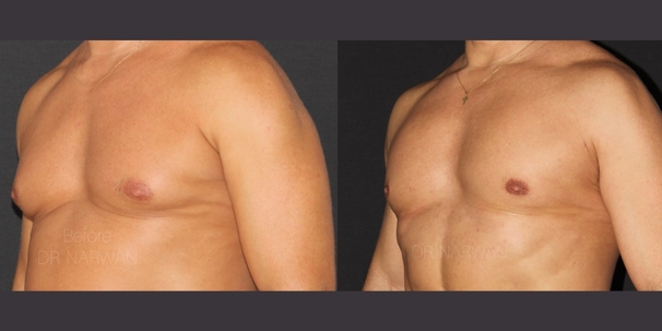 treatment-gynecomastia-01-dr-narwan-plastic-aesthetic-surgeon-dubai.jpg 