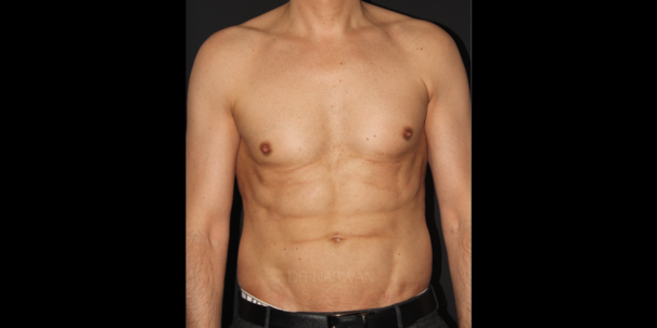 treatment-body-men-05-dr-narwan-plastic-aesthetic-surgeon-dubai.png 